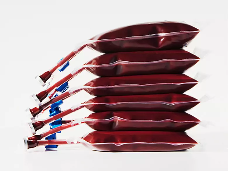 Układowe zapalenia naczyń - przyczyny, objawy, diagnoza, leczenie