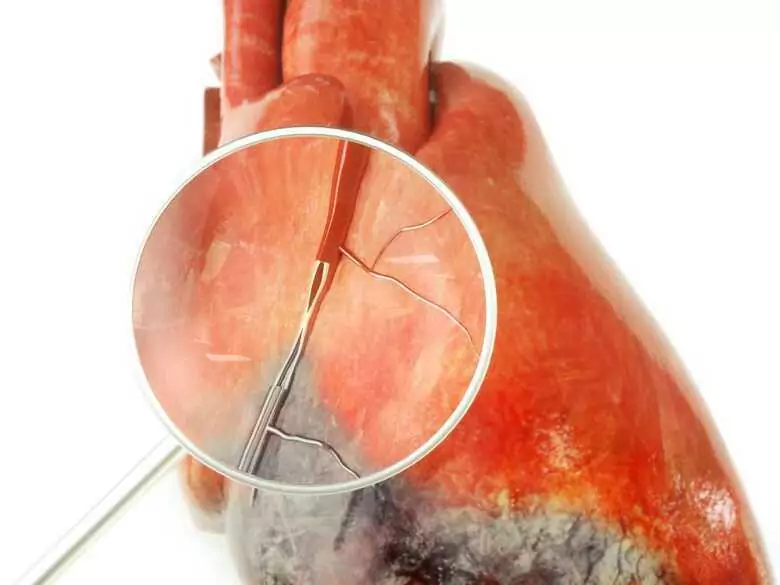 Jak leczy się chorobę niedokrwienną serca? Wszystko, co należy wiedzieć o stentach