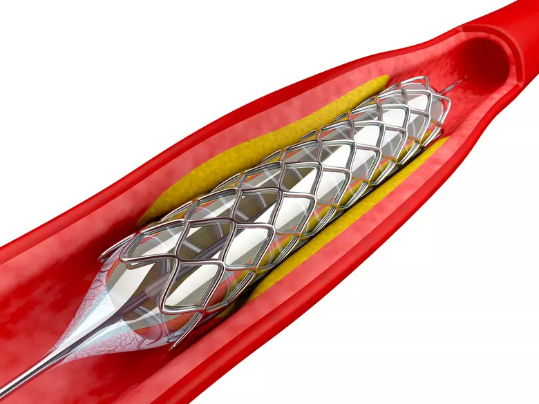 Tętniak aorty - przyczyny, objawy, diagnoza, leczenie