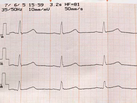 Zaburzenia rytmu serca - przyczyny, objawy, diagnoza, leczenie